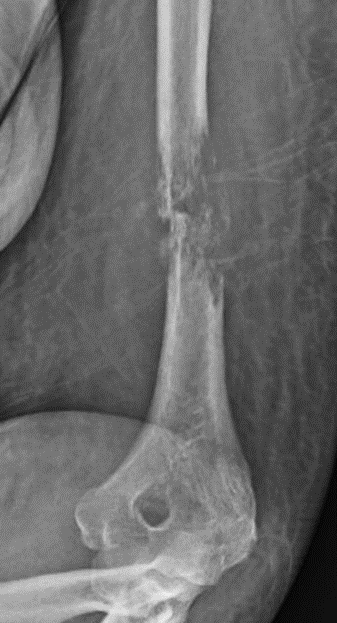Metastatic Image 2