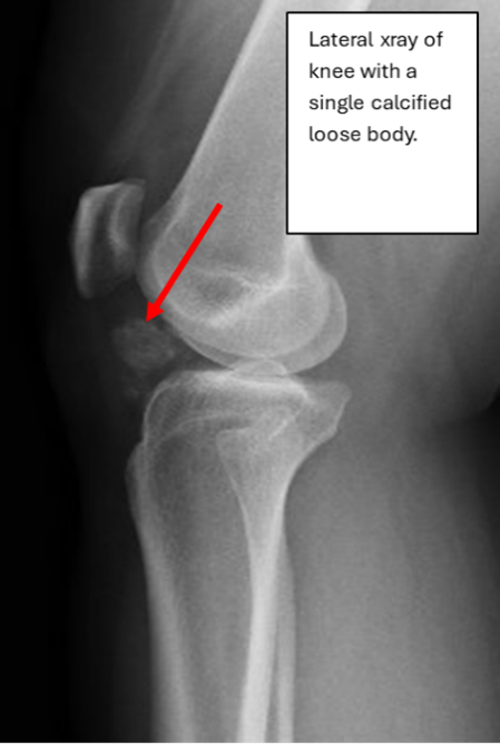 Lateral X-Ray of the Right Knee