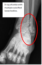 X-ray of a left angle with multiple loose bodies within the ankle joint