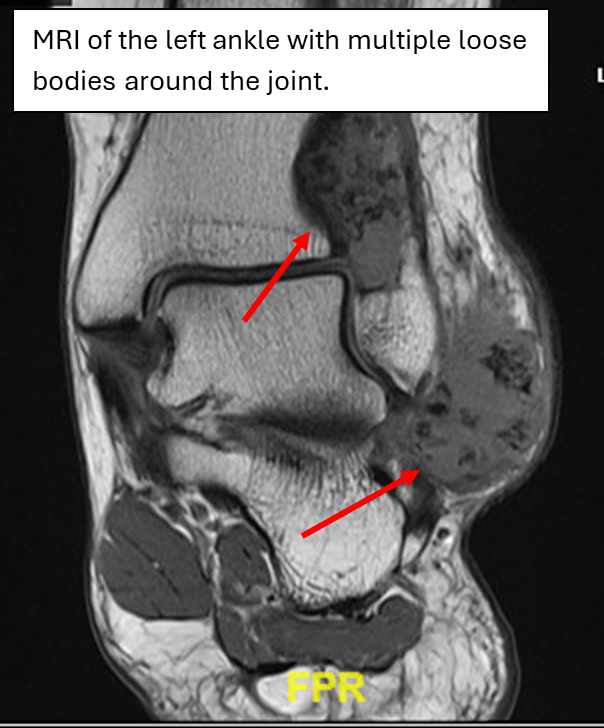 Coronal  T1 MRI of a left ankle with multiple loose bodies within the joint.