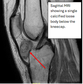 Sagittal MRI of the Right knee.