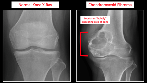 Chondromyxoid Fibroma Figure 1