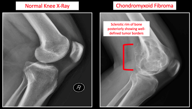Chondromyxoid Fibroma Figure 2